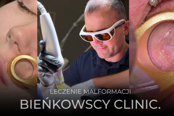 naczyniowe malformacje leczenie